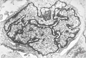 M, 11y. | mycosis fungoides v.s. - cerebriform nucleus of Sézary cell